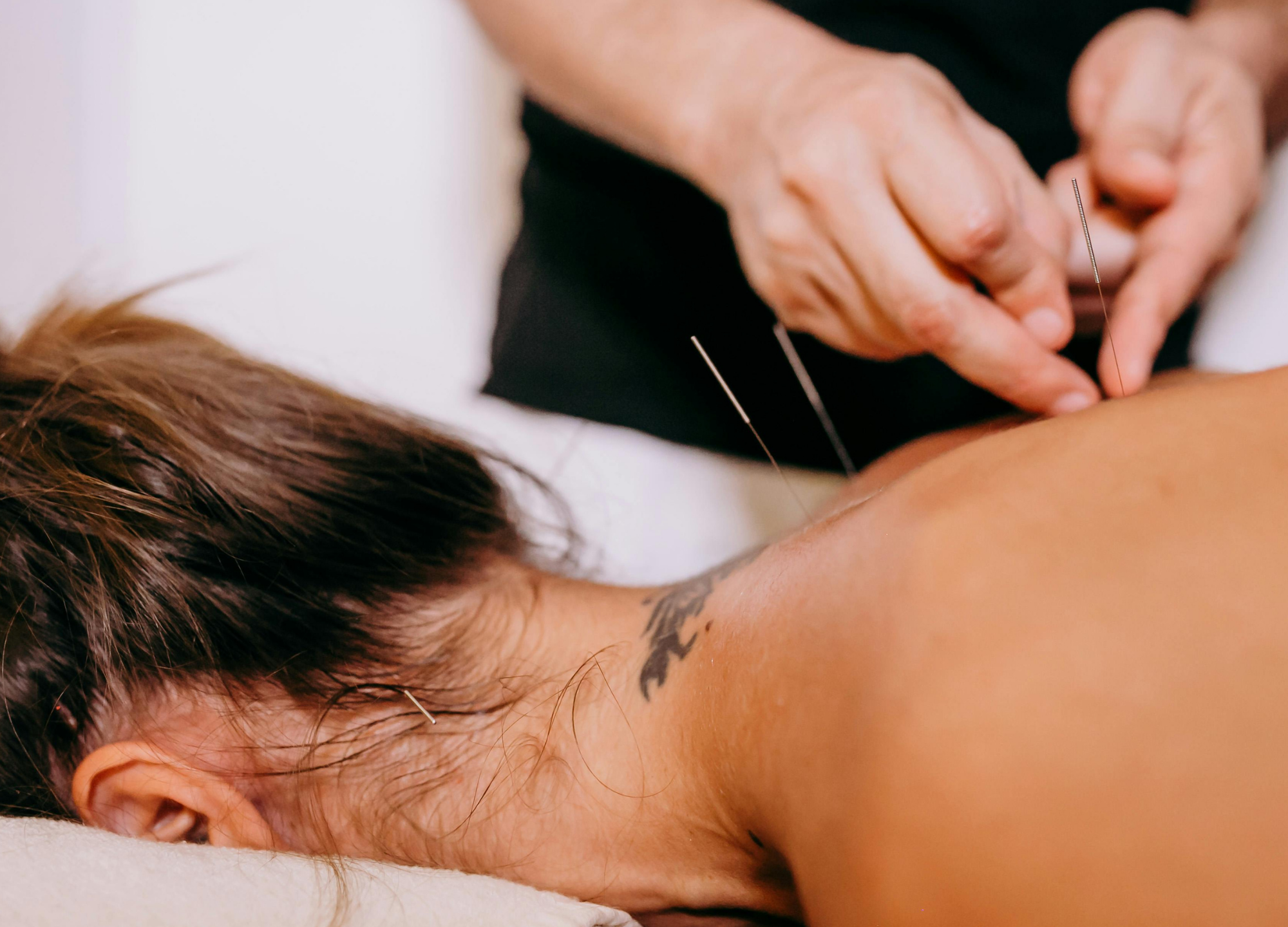 Clinical dry needling session